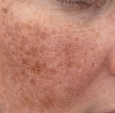 PIGMENTATION