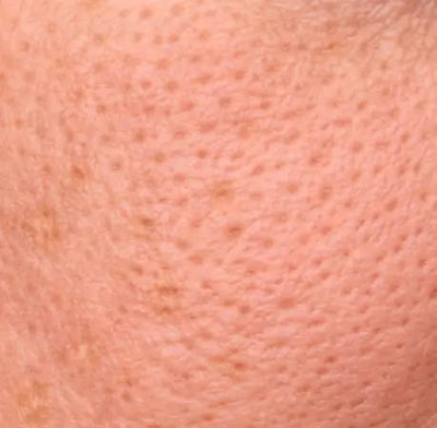 ENLARGED PORES