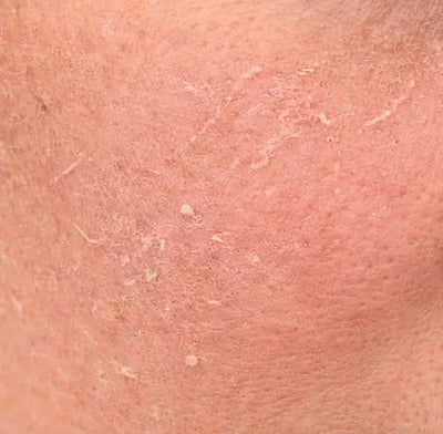 DRY SKIN