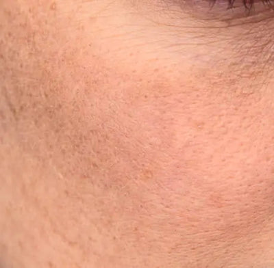 TIRED & DULL SKIN